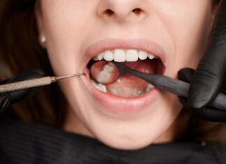Co to są cementy dentystyczne i jakie jest ich zastosowania w stomatologii