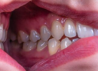 Wizyta u dentysty bez stresu. Praktyczny poradnik krok po kroku zęby przed zabiegiem higienizacji